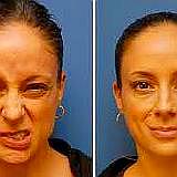 Correzione delle asimmetrie del volto